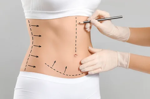 Liposuction in Dubai 