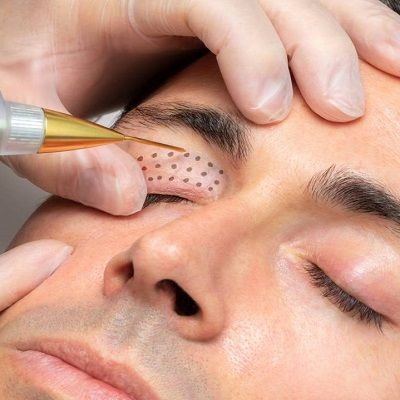 What Is Plasma Pen Treatment?