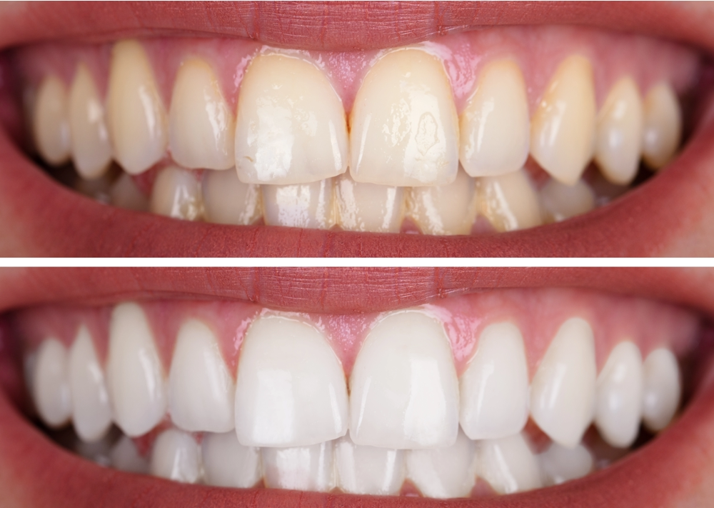 What to Expect for Your Whitening Budget in Dubai