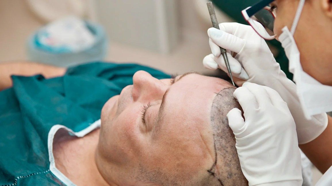 Unlock Hair Beauty Magic Instantly With Hair Transplant Cost