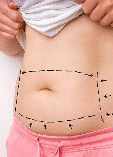 What to Expect from a Tummy Tuck in Miami: Step-by-Step Guide